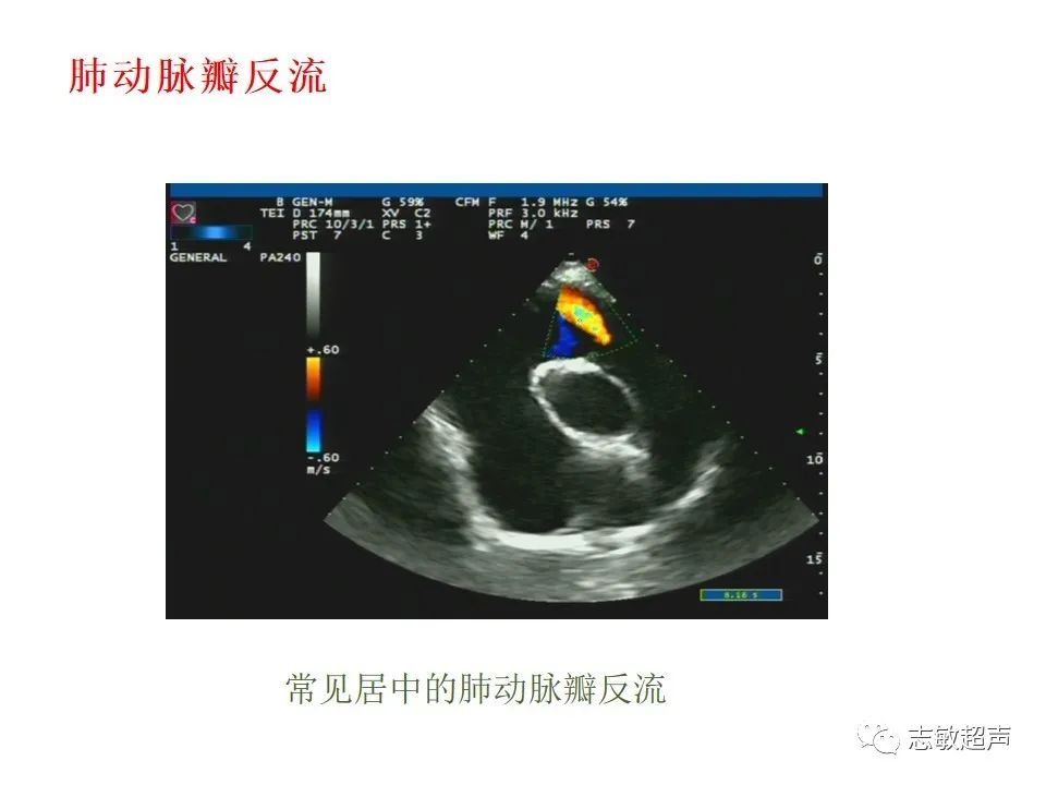 超声|肺动脉瓣周边异常血流的超声鉴别