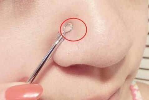 鼻子两侧挤出来的白色物质是什么 皮肤科医生一次性给你说明白!