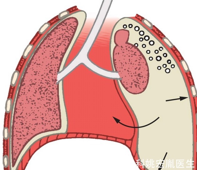 回事|气胸是怎么回事?