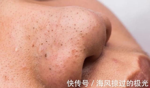 泡沫|看到黑头就想挤担心越挤越多!网上3种方法才损伤皮肤,要避开