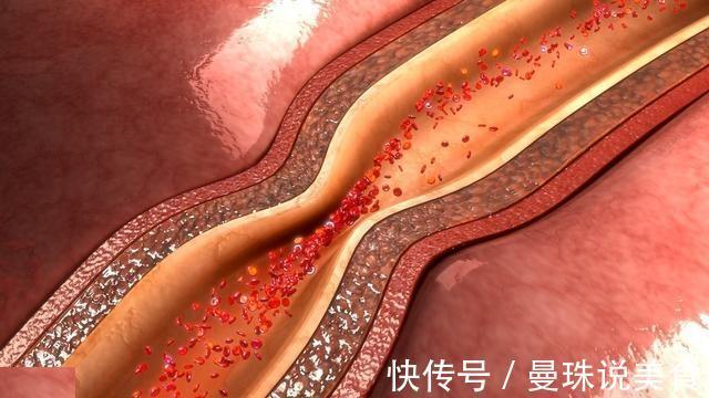 脑血管|中风为何越来越多医生苦劝这3件事危害很大,很多人却在做!