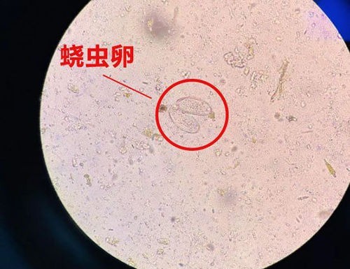 感染|2岁女儿患上“蛲虫病”,得知原因后,宝妈直接气得带孩子回娘家