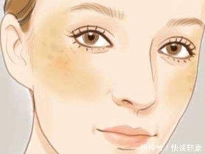 激光|困扰大多数人的色斑,到底用什么办法才能去除?