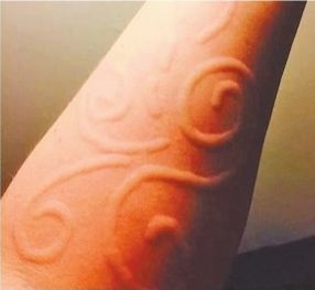 荨麻疹|他们患上荨麻疹后变身为“画家”