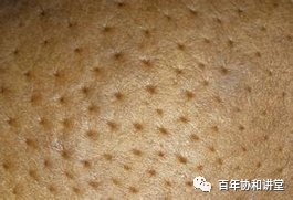 乳腺癌|【百年协和讲堂】乳房出现肿块？发红发热？乳头溢液？酒窝征？…有可能是乳腺癌！