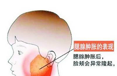脸颊肿胀诊断为腮腺炎,后来检查是腮腺