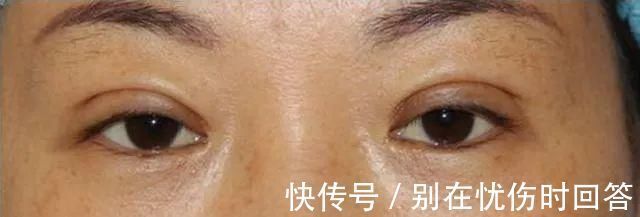 肉条感|双眼皮术后出现肉条的不同原因和修复方法