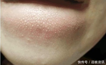 白色|下巴处冒出的白色小疙瘩,看过去连成一片,多半是因为螨虫撕咬!