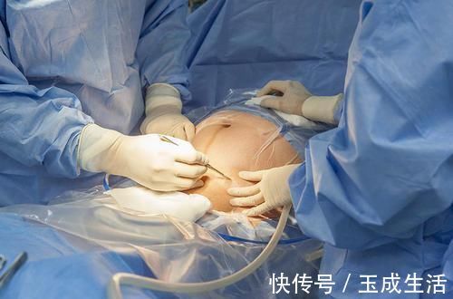 杨院长|女人可以做几次剖腹产不是三次和五次,医生不要超过这个数