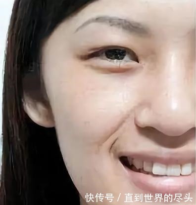 医美 法令纹是怎么来的法令纹填充如何避免僵硬_芯动医美课堂!