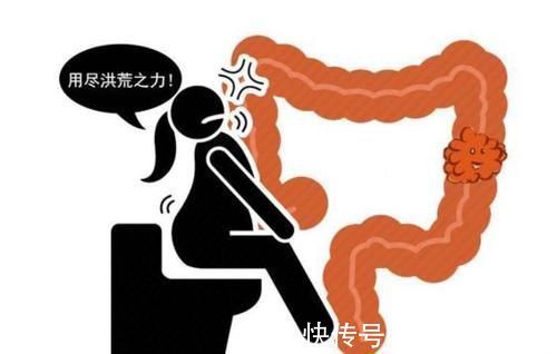 恶性肿瘤|直肠癌多半是拖出来的?4种异常迹象,暗示直肠已“亮红灯”