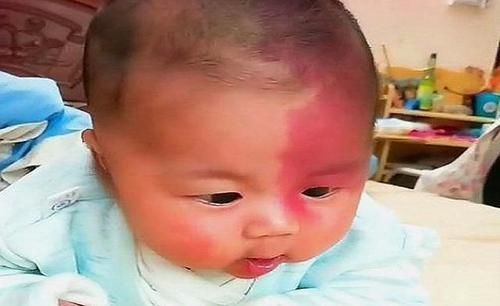 化学物质|胎记是怎么来的?产科大夫:除了遗传,孕期的这3种行为尽量避开