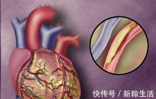 胆固醇|高血脂最爱3种肉,若能做到忌口,血脂自己往下降,人健康10倍