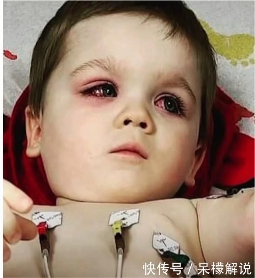 双眼|外国小孩儿洗澡后双眼通红,原来是粗心母亲忘了小心“小黄鸭”