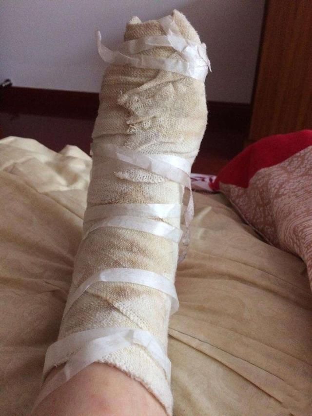 不小心烫伤了怎么办?千万不要自行乱涂牙膏等东西