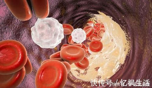 配方|打通血管血栓的绝密配方,一个月内阻塞血管全部疏通?