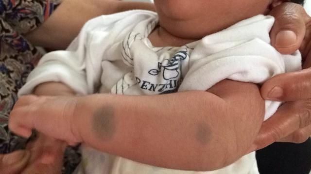 宝妈|宝宝出生屁股“淤青”,不要以为是天生,可能宝妈孕期做了这些事