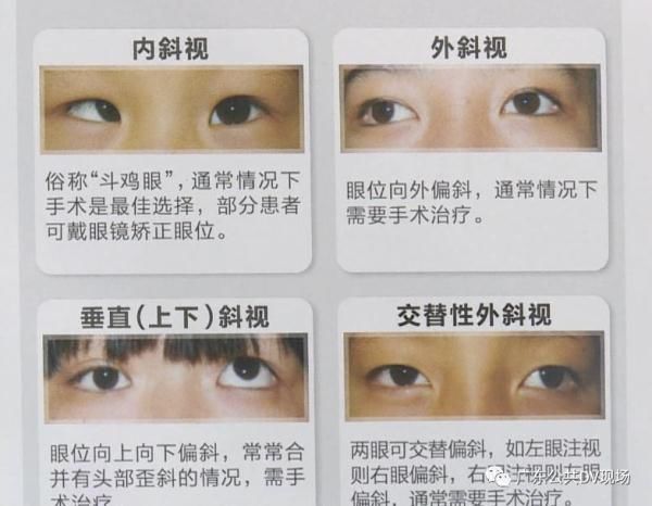 小美|每天看手机超5小时，11岁女孩眼珠子“斜”了