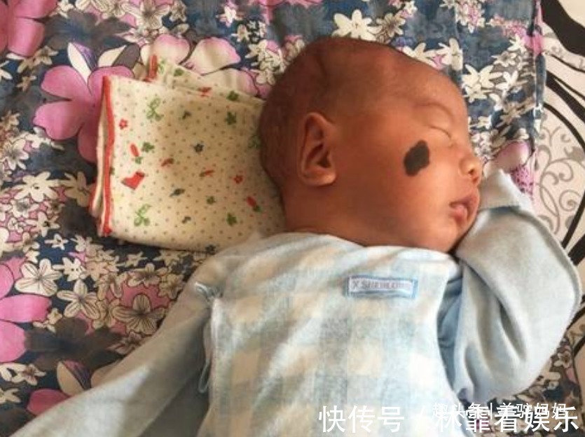 蝙蝠侠|越来越多胎儿被“胎记”缠身,若不想孩子自卑,孕妈要管住自己