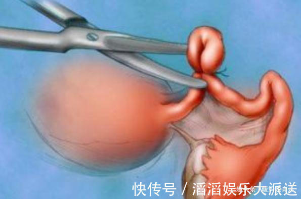 精子|女性选择“结扎”之后,还会有生理需要吗这点可能很多人想不到