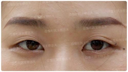 逼疯强迫症的一单一双眼皮，手术能不能只做单侧？