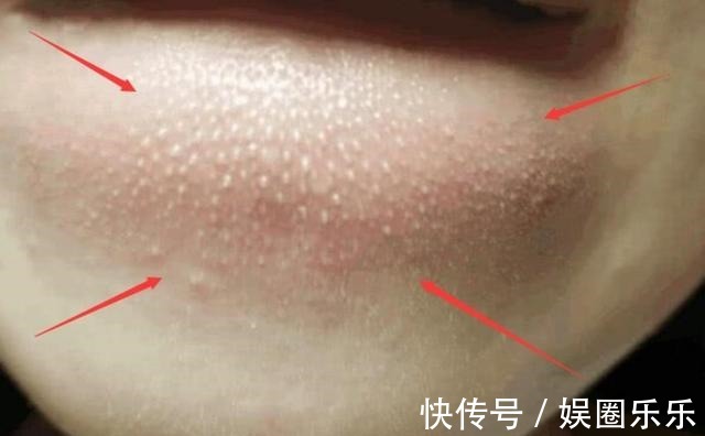 颗粒|抿起下巴凸起的小颗粒和痘痘, 究竟是什么 趁早知道, 否则越长越丑!