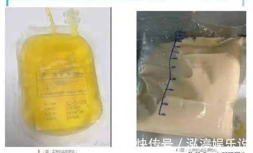 血脂|高血脂不疼不痒无需在意辟谣高血压长期不控制会导致这些疾病