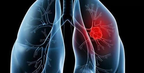  检查|平时没有症状，一检查却是肺癌只因忽略了肺脏受损的这些表现