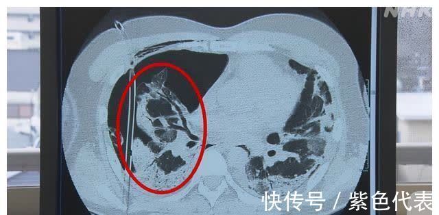 肺部|日本新冠患者2个月的治疗过程 挣扎在生死边缘