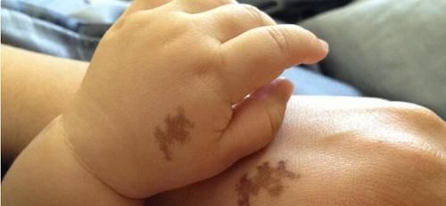 胎记|胎记是怎么来的产科医生孕期远离3种行为，避免胎儿长记号