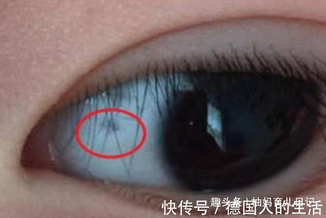 胎记|女娃眼里出现多个黑点,奶奶自以为的“哄娃神器”,正是罪魁祸首
