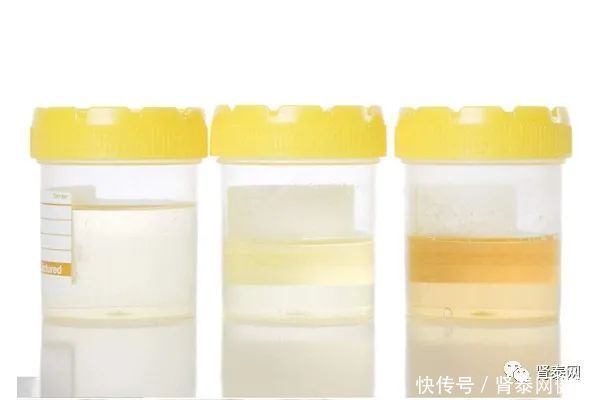 尿白细胞增多是尿路感染吗?