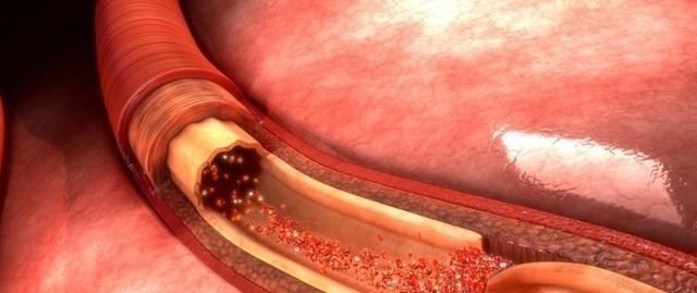 木耳|“溶栓高手”被发现，不是木耳跟洋葱，敞开喝，血管悄悄变干净