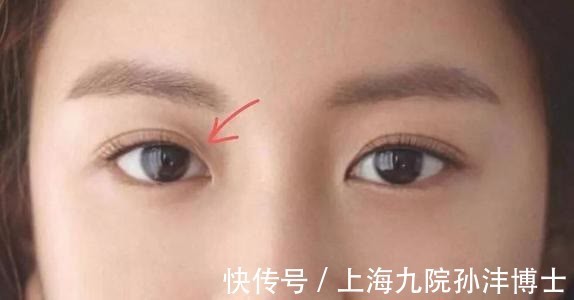 双眼皮 眼修复孙沣博士:双眼皮术后出现分叉能修复吗?