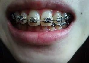 患者|为什么“磁共振”尽量不要做？或许你还不明白，检查这2点需注意