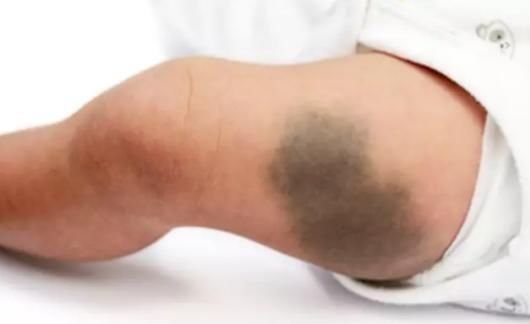 宝妈|宝宝出生屁股“淤青”,不要以为是天生,可能宝妈孕期做了这些事