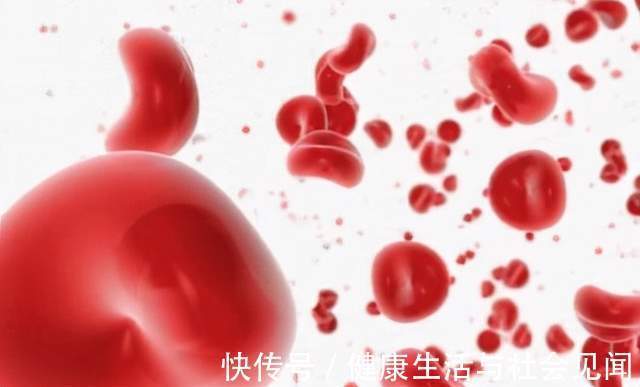 乏力|频繁头晕、乏力可能是贫血!谢别录:贫血有很多种,看你是哪一种