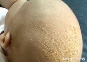 败血症|新手爸妈粗心大意, 宝宝出生不到一个月就得了败血症