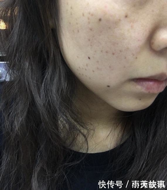 偏高|血脂偏高的人,头部或有4个表现,若想调节血脂,给你2个小建议