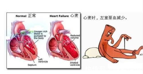 心力衰竭|冠心病会导致心力衰竭吗?到底是为什么呢?早知早受益!