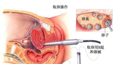胚胎|揭秘试管婴儿全过程(附图)，看完后心疼女性一万遍