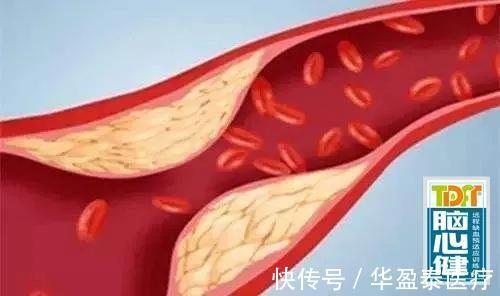 糖尿病|高血压、高血脂、高血糖三者的相互关系