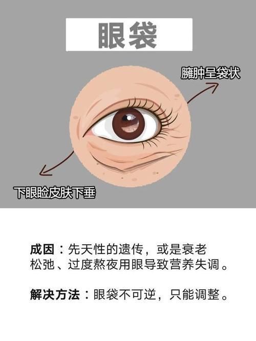 眼部|黑眼圈 、眼袋、 眼角纹、 脂肪粒，它们的形成原因你知道吗？