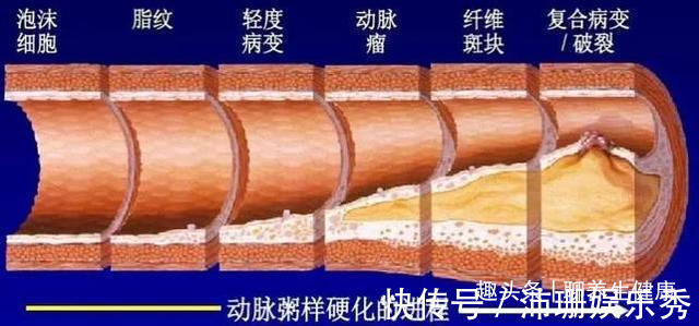 黄花草油酸|89岁朱晓东院士提醒：若血脂升高，这2种素食要尽量少吃，应牢记