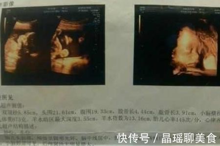 四维彩超|做了四维后,谁见了彩超都说宝宝长得丑,生下来后妈妈得意了!
