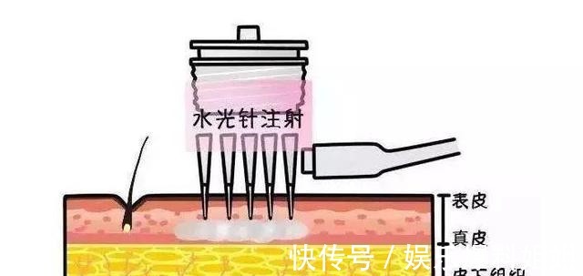 补水 水光针术后需要注意什么!