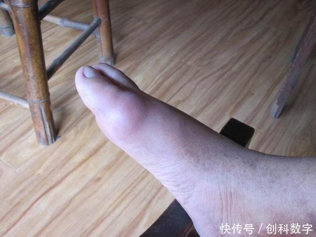 痛风|降尿酸“高手”藏在厨房，平时这样吃，尿酸降下来，痛风不见了