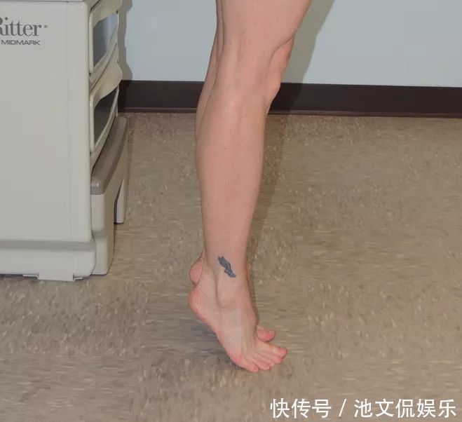 后跟|跑完步脚后跟痛?没关系,三招教您缓解跟腱痛!