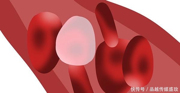 恢复正常|血脂高先别慌,甘油三脂若没超这个数,做到四点血脂或会恢复正常