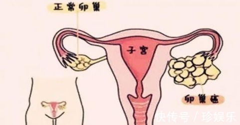 腹痛|“卵巢有癌,腹部先知”身体出现3种异常,可能是癌症在靠近